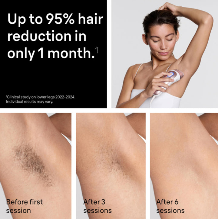 Braun Smart IPL, Skin iÃ‚Â·Expert Pro 7: at Home Laser Hair Removal, Permanent Visible Hair Reduction, Vanity Case, Venus Razor, 3 Smart Heads, IPL7243